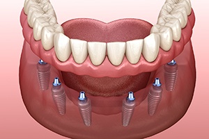 Digital illustration of implant dentures in Gainesville