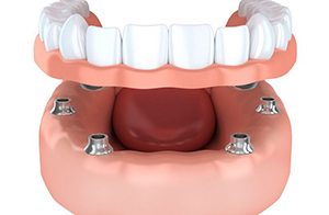 implant-retained dentures in Gainesville