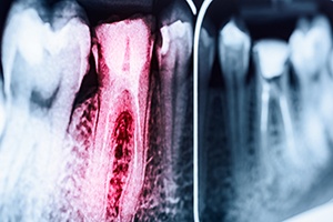 X-ray with tooth highlighted red
