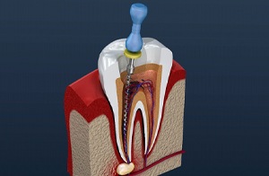 Image of root canal procedure on infected tooth.