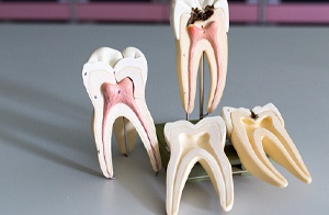 Model of root canal therapy.