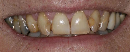 yellowed teeth before